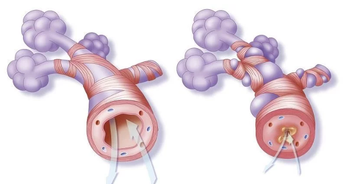 支氣管為什麼會發炎,慢性支氣管炎到底的誘因是什麼?