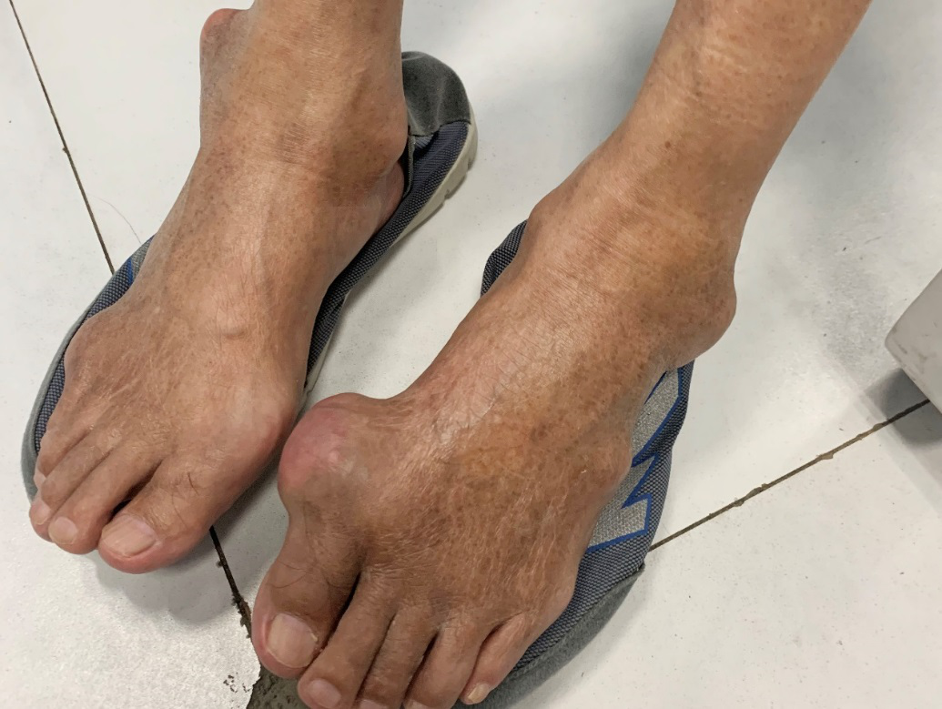 痛风多年,他尝试"偏方" 险中毒,为什么没早点遇到不石先生