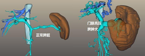 關於肝硬化失代償期,這些你都清楚嗎?