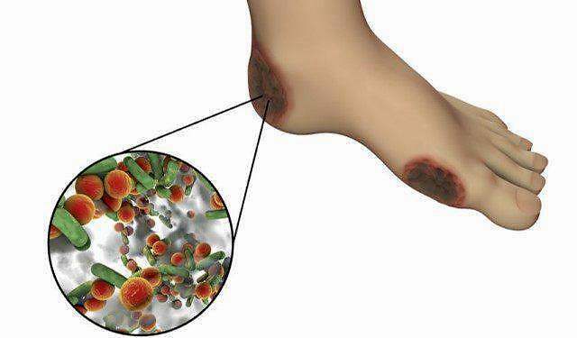 糖尿病足烂脚是怎么形成的 凤凰网