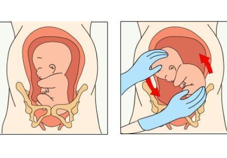产科秘术——外倒转术 