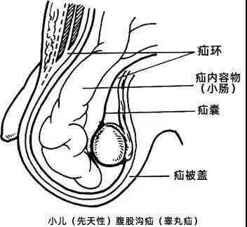 新生儿睾丸图图片