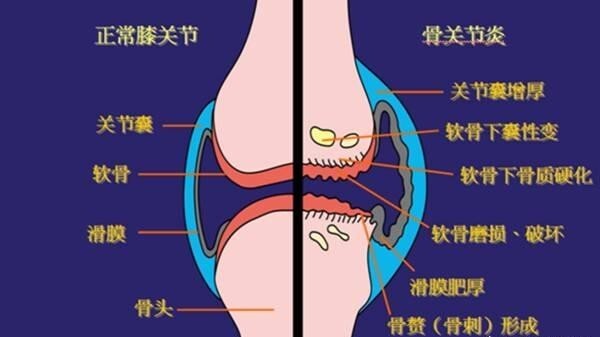 出現關節疼痛需留心,不要錯把類風溼性關節當成骨關節炎!__鳳凰網