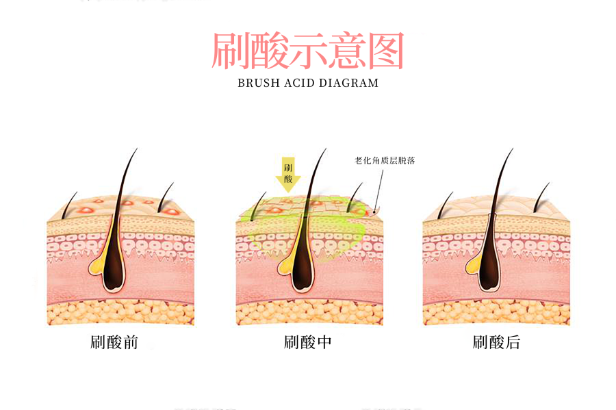 刷酸有哪些注意事项?