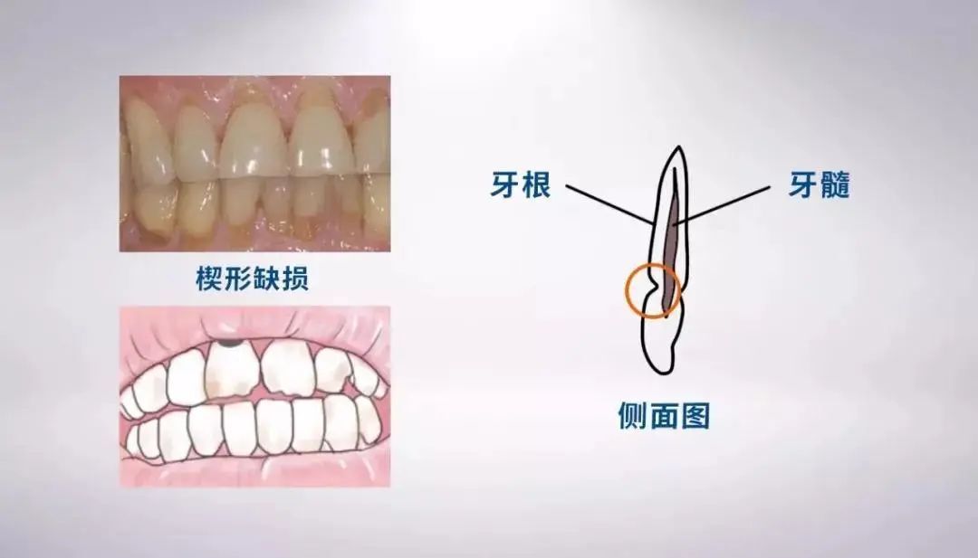 楔状缺损画图图片