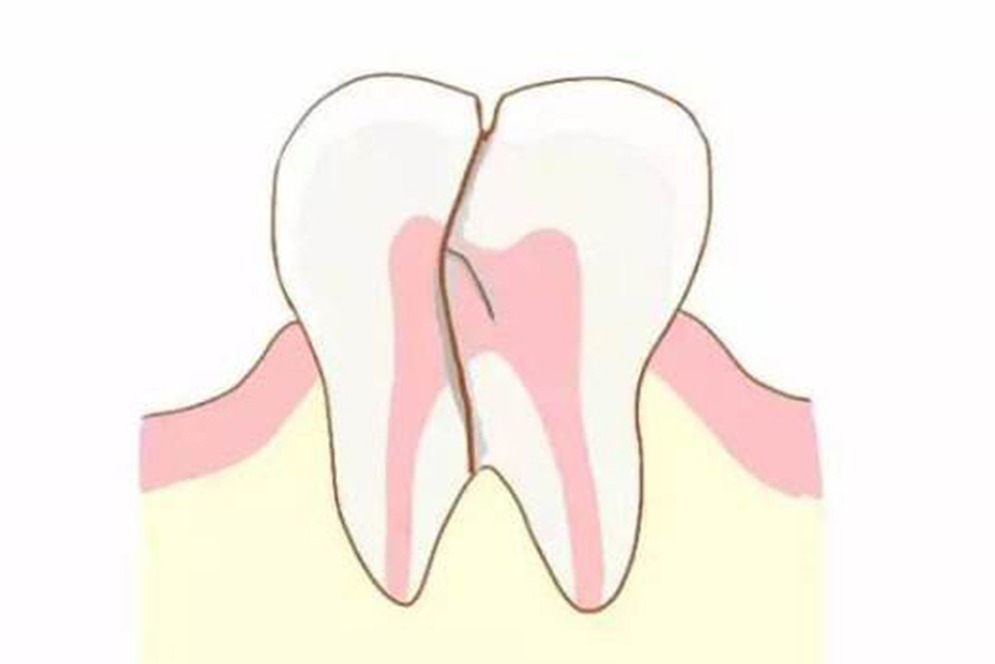 牙齿出现裂痕是怎么治疗的