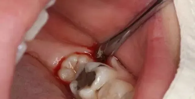 小孩子去拔牙要打麻药?对发育有影响吗?