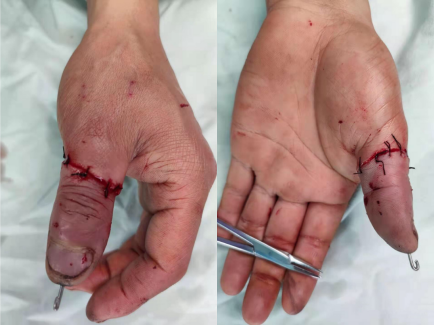 工人大拇指被据断 4小时后显微镜下重新接活