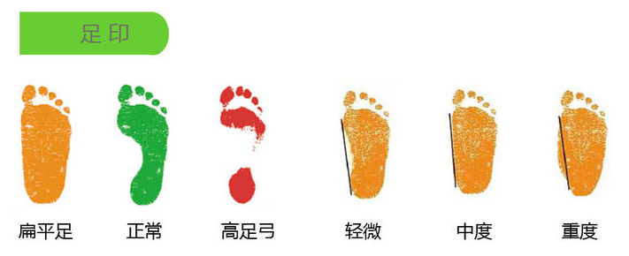 可能是扁平足!穿鞋需要更注意__凤凰网