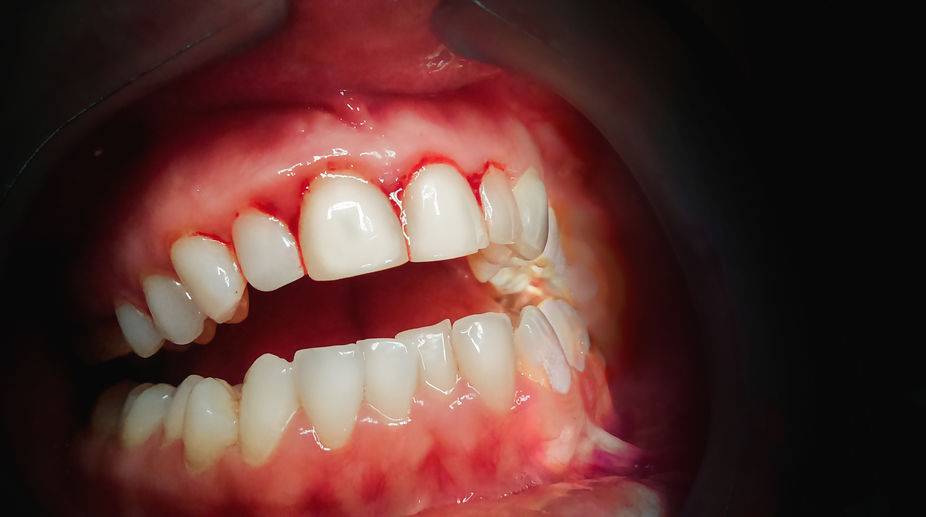 正常人牙龈内侧图片图片