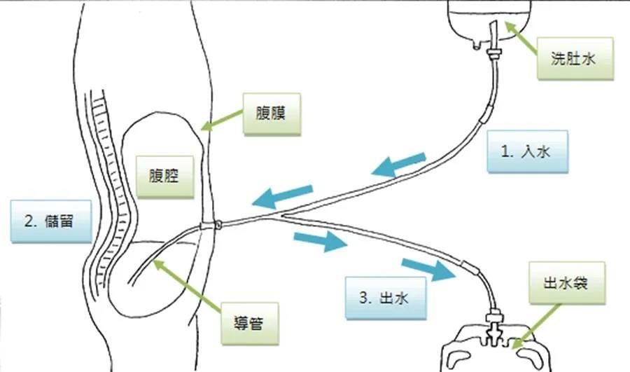 腹膜透析?血液透析?哪种方式更适合呢?__凤凰网
