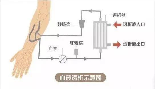 血液透析?哪种方式更适合呢?