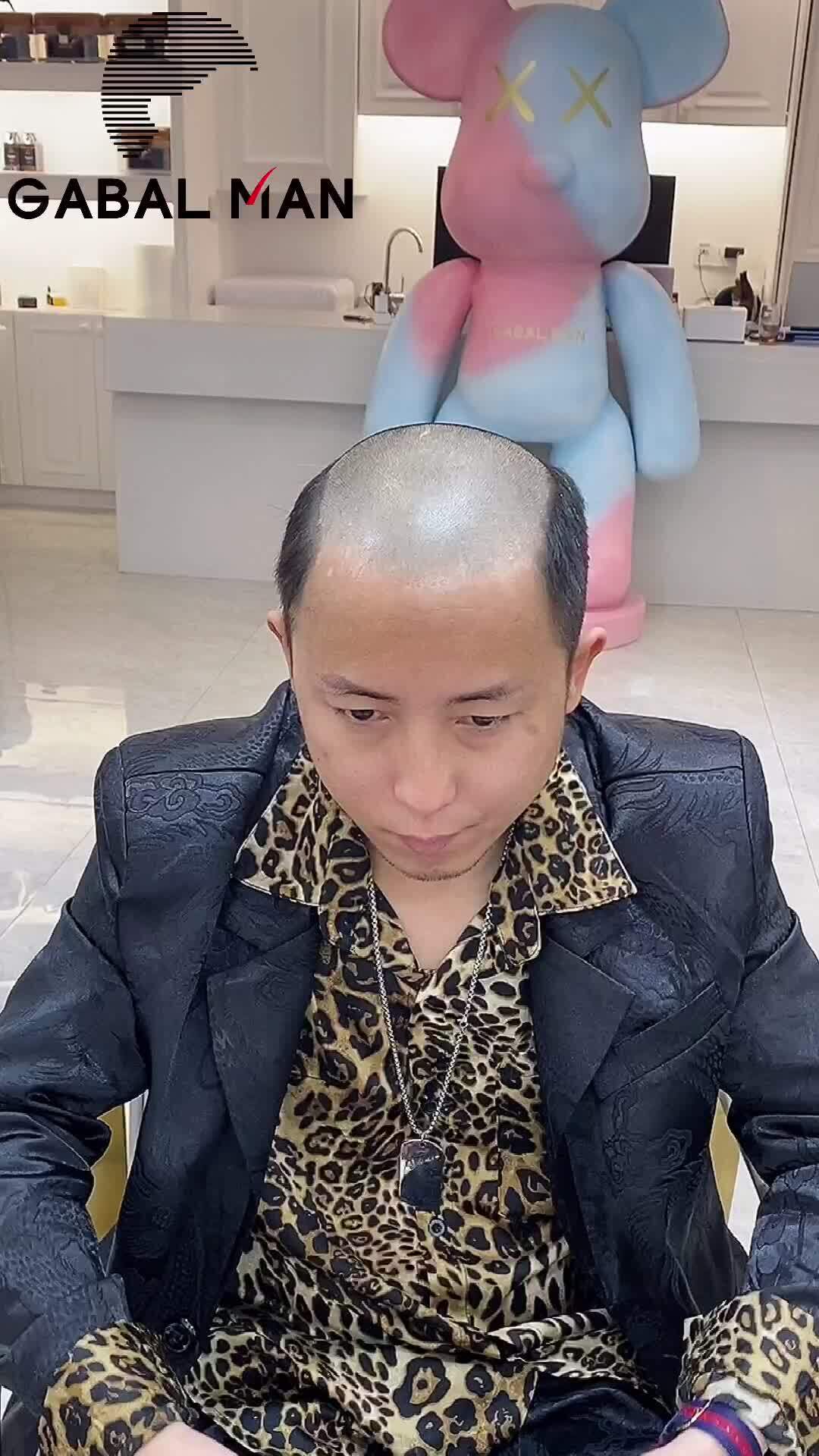 脱发人士别错过非手术物理增发2小时发量变多