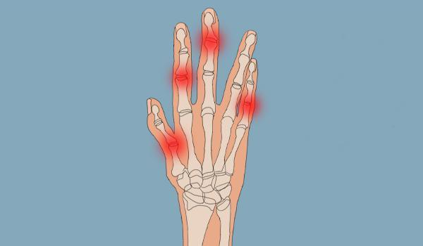 手指关节疼痛,是哪些疾病的信号?列出几种可能性,不妨对照一下