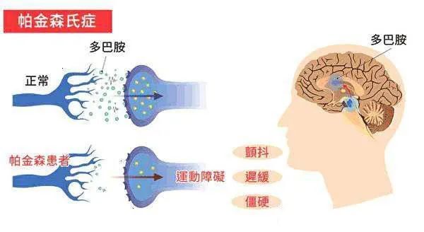 帕金森患者颤动的命运,就由干细胞来改变!