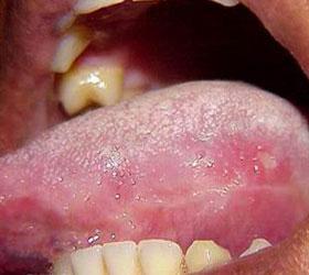 白塞病能自愈吗?自愈的可能性大吗?