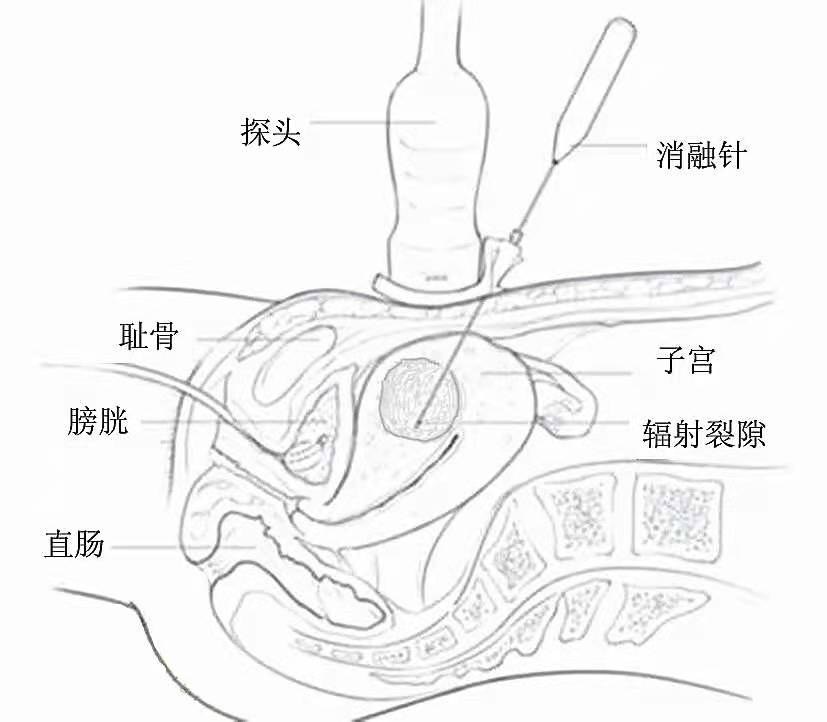 原来,近五十岁的张女士已经就诊多家医院,医生均建议手术切除子宫,张