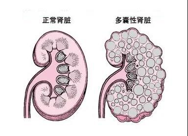 多囊肝图片清晰版图片