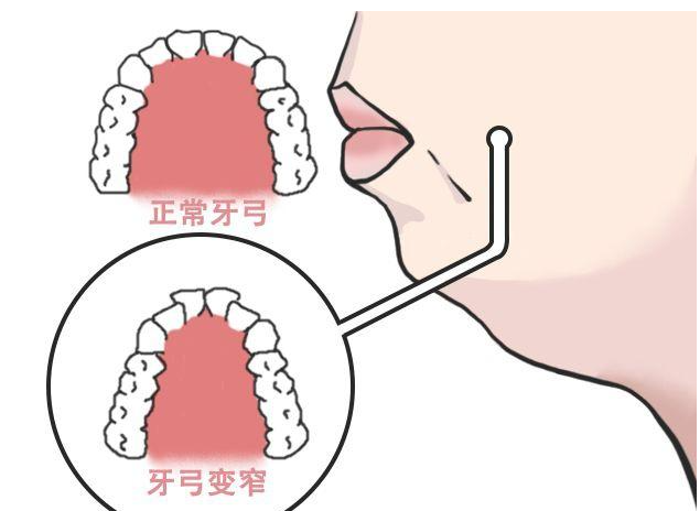 你的龅牙,嘴凸,深覆合,都有可能是因为这个原因引起的!