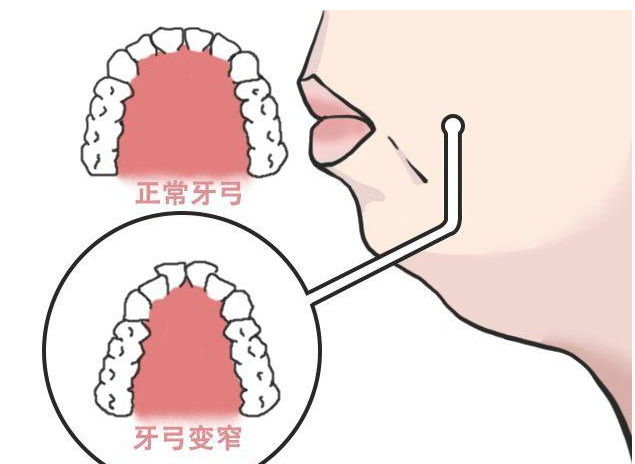 牙弓狭窄图片