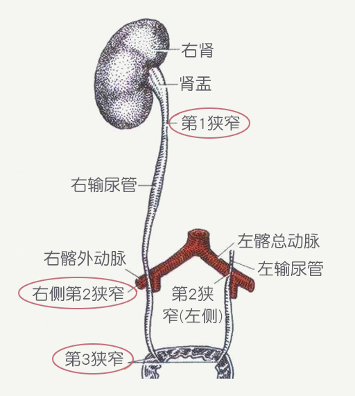 输尿管三个狭窄图图片