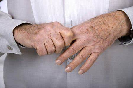 如何做到类风湿性关节炎的早期诊断,难道你还没有规范治疗吗?