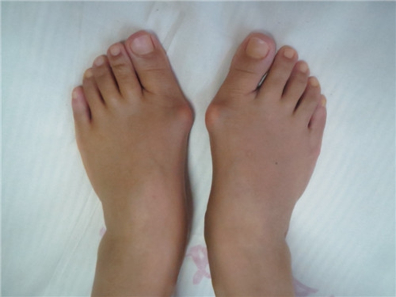 由于大拇趾外翻,挤向其余四趾,脚的前面呈三角形,时间长了,常见脚的第