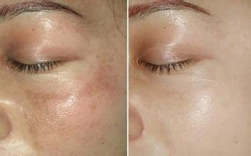 有哪些好用的消除脸部色斑方法