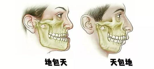 如何分析自己是轻度地包天还是重度地包天?