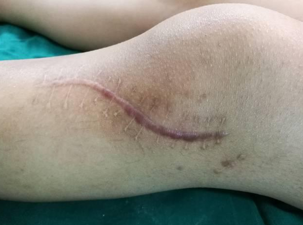 拉皮缝合越晚拆线越好吗?时间长皮肤会更牢固吗?__凤凰网