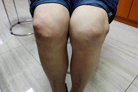 膝盖痛风图片症状图片