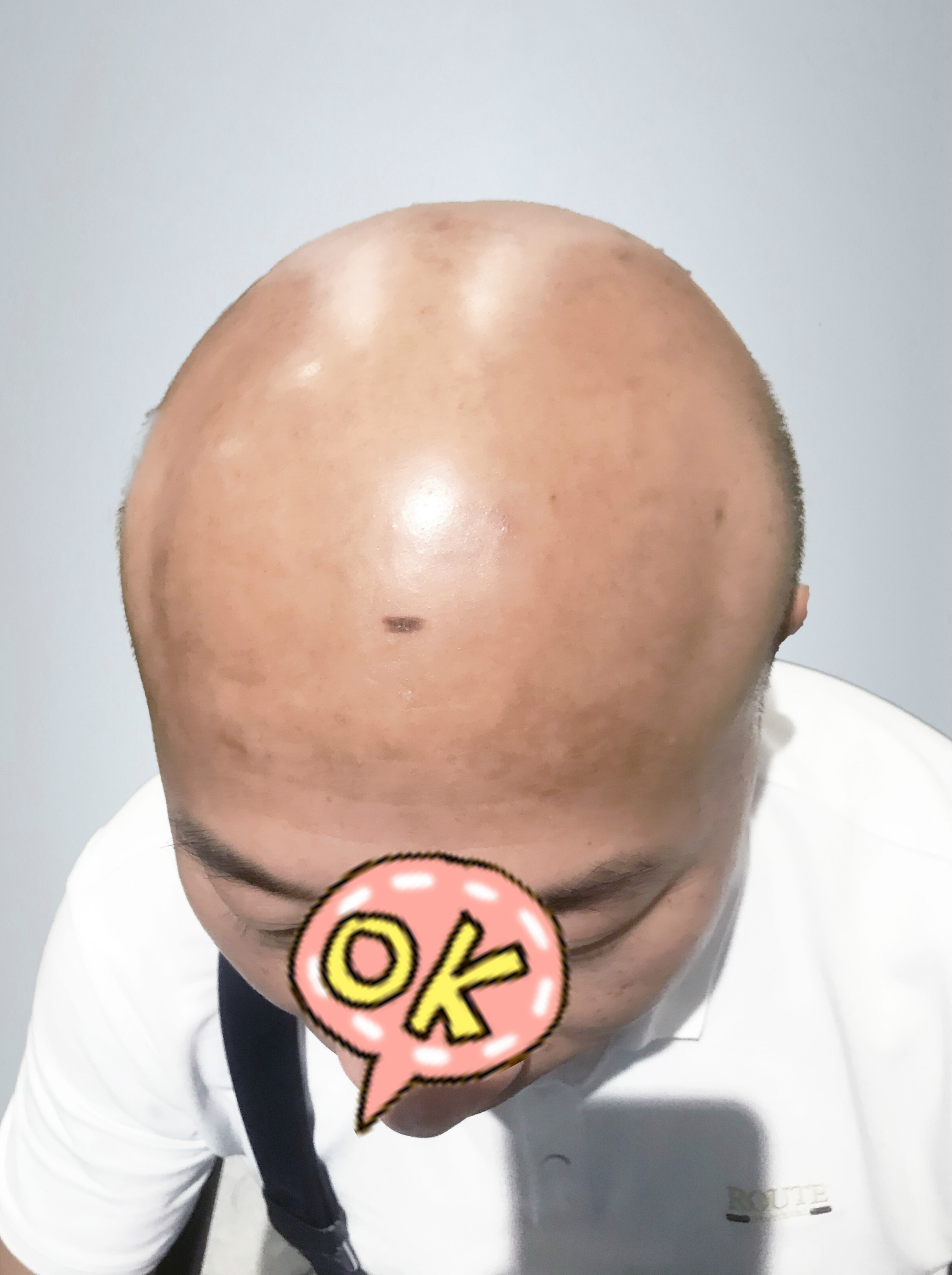 从光秃秃的脑袋,到浓密的头发,他只花了一顿午饭的时间 __凤凰网