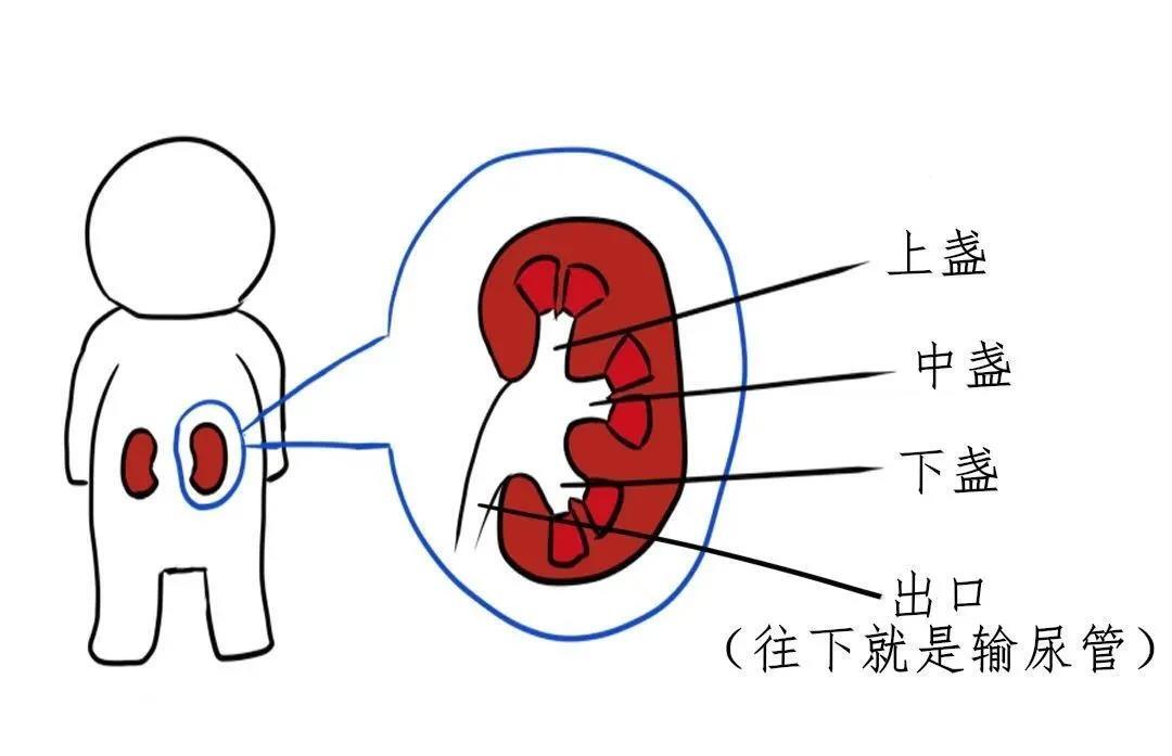 肾结石排出示意图图片