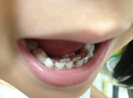 部分儿童在换牙期时,恒牙萌出但乳牙还没掉,这种情况就叫做乳牙滞留