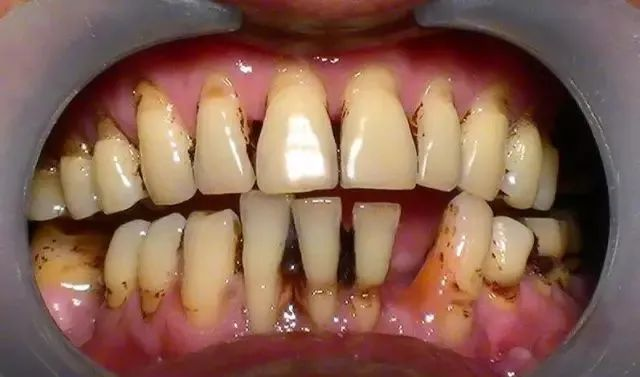 3,  严重蛀牙造成的残根残冠