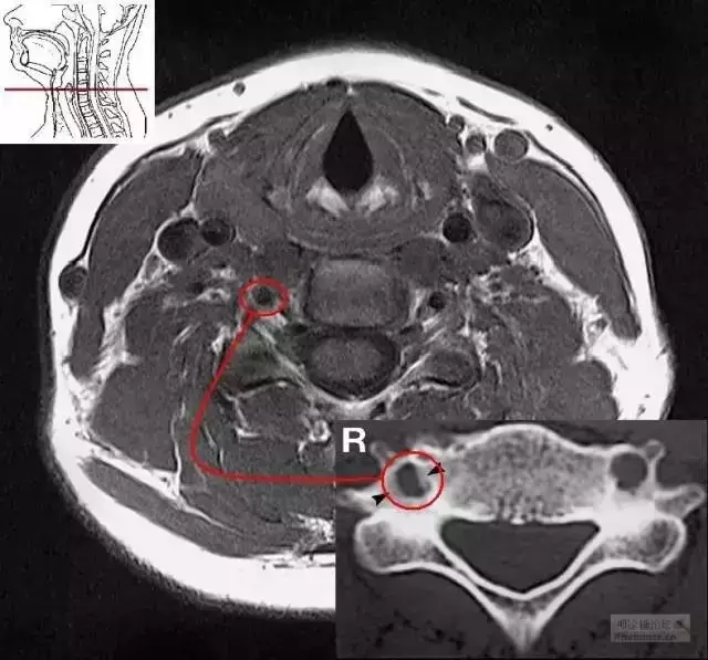 9个典型病例让你明白颈椎病为何会引起眩晕?