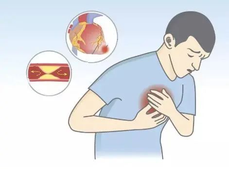 乏力,气促,头晕,严重者如急性心衰发作,会出现夜间阵发性呼吸困难