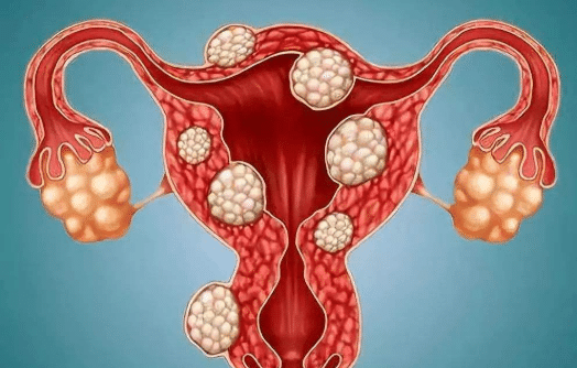 妇科大夫提醒:5个行为容易让子宫肌瘤"猖狂",尽早避开