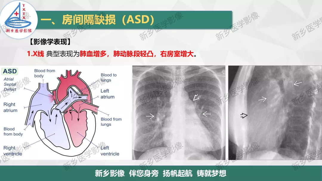 【一圖明白】房缺,室缺,動脈導管未閉如何分型?