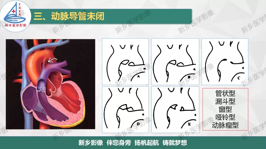 【一圖明白】房缺,室缺,動脈導管未閉如何分型?