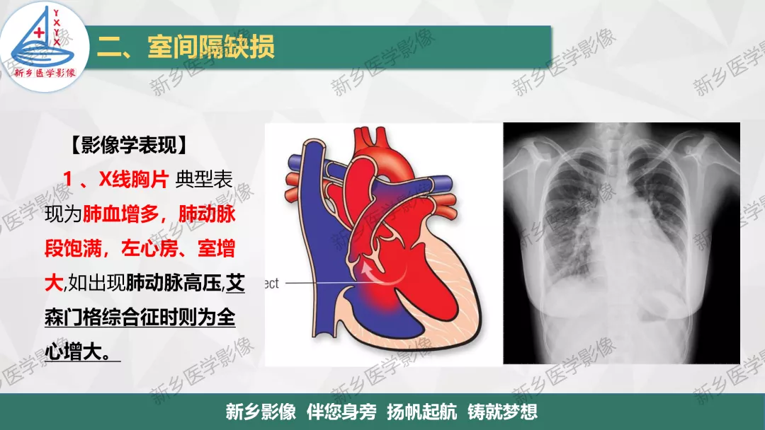 【一圖明白】房缺,室缺,動脈導管未閉如何分型?