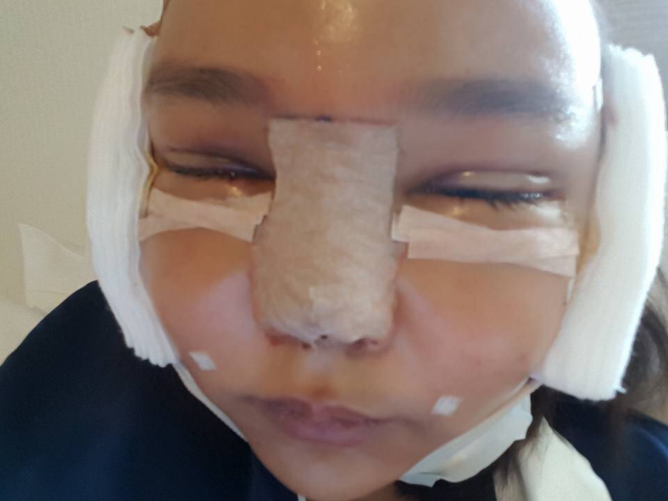 泰国网红4姐妹整容后绑绷带上街吓坏网友