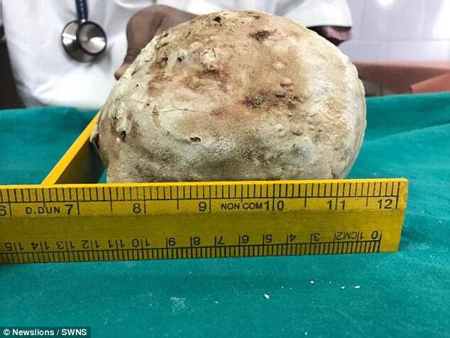 5厘米 x 17厘米,重1.5公斤的结石,手术时间持续一个半小时.