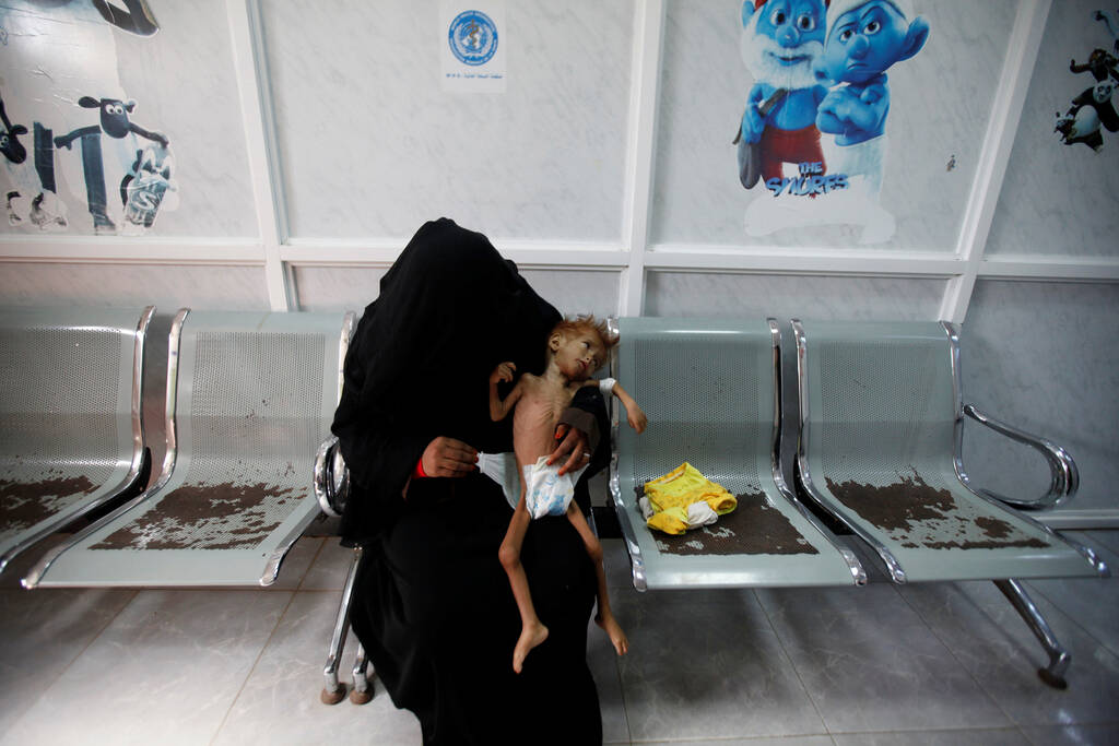 也门战事持续 儿童瘦成皮包骨