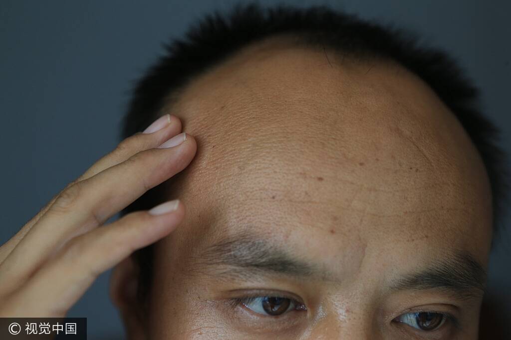 西安出租车司机车祸中救4条命 如今脑袋长瘤失聪