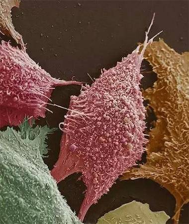 看显微镜下的各类癌细胞:画风完全不一样