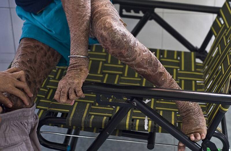 越战遗留化学试剂致婴儿畸形