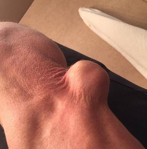 wwe悍将惊人肘伤 胳膊凸起似塞高球