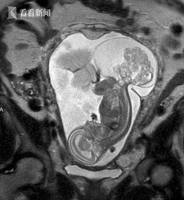 周做常规产检时,被医生告知,未出生的婴儿患上了一种罕见骶尾部畸胎瘤