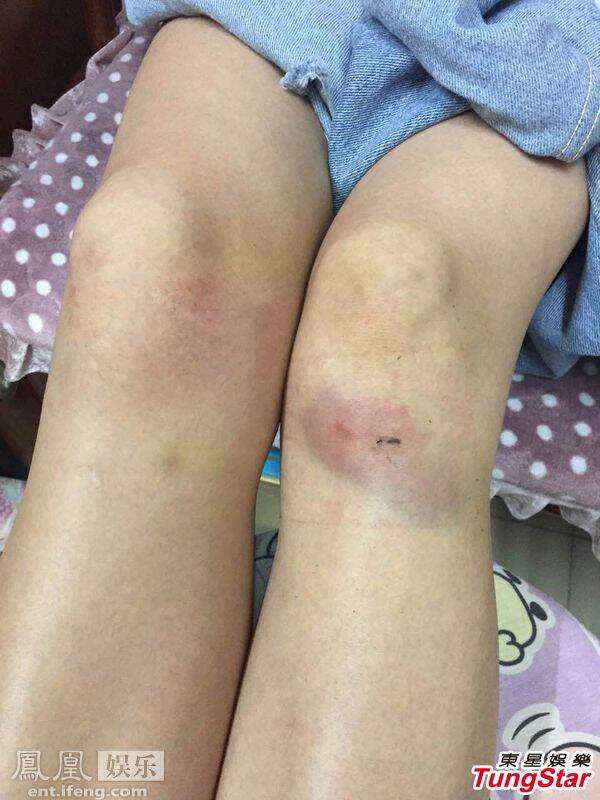 周秀娜拍戏意外受伤跪地 双膝青肿惹人疼